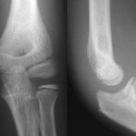 elbow xr Elbow