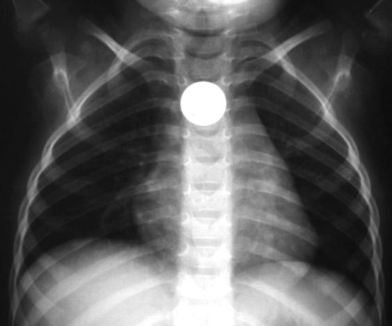 Αποτέλεσμα εικόνας για foreign body oesophagus